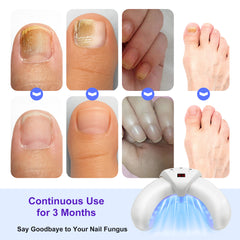 New Nail Fungus Laser Treatment for Toenails and Fingernails Home Use Reliable