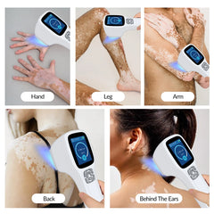 ZJZK Excimer Therapy UV Light And Psoriasis UVB Light For Viral Infectious Skin Disease